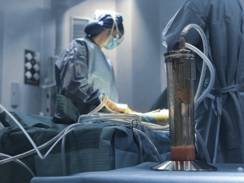 Liposucci�n Agualipo